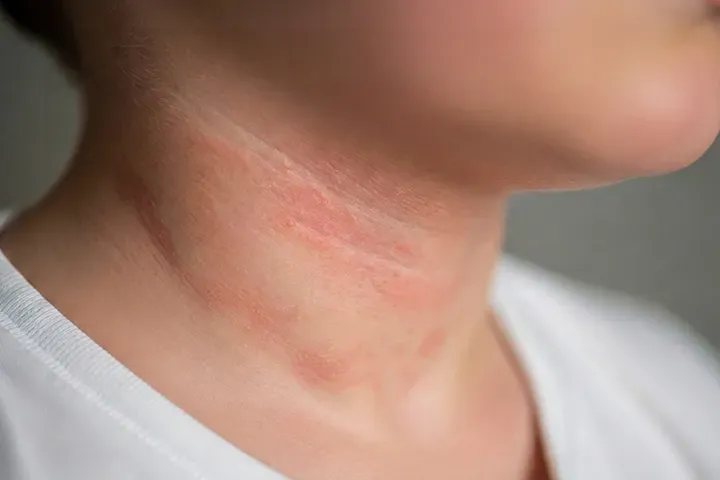 子どもの花粉症で肌荒れ?花粉皮膚炎の症状と対策を小児科医が解説