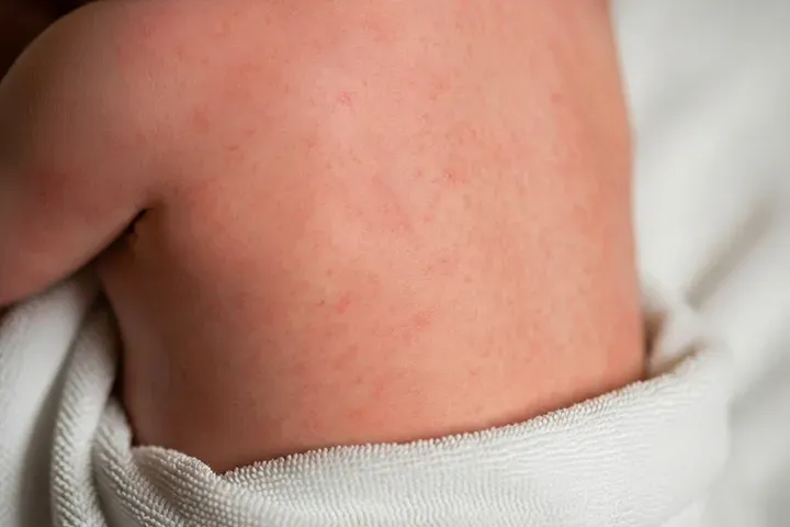 子どもの突発性発疹は保育園いつから?登園の目安・受診のタイミングを小児科医が解説