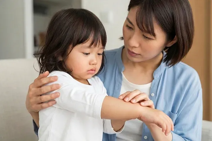 子どものとびひ（伝染性膿痂疹）：症状・治療と保育園の登園目安を小児科医が解説