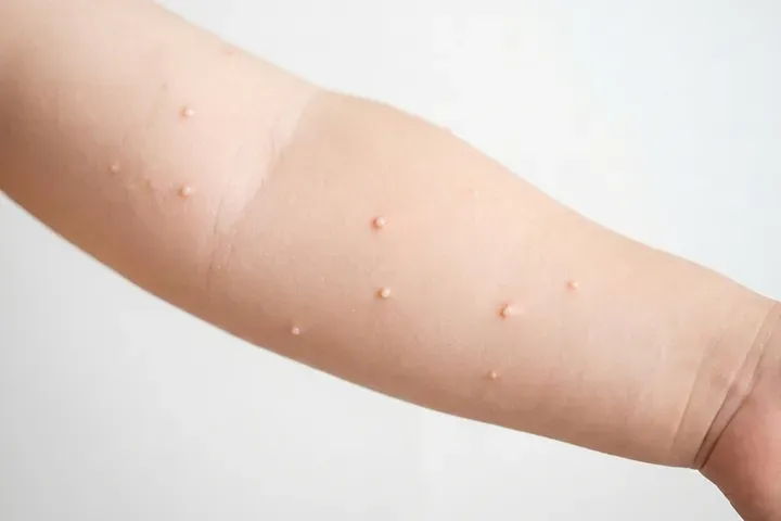 水いぼは子どもから大人にうつる？原因・症状・治療と予防を小児科医が解説