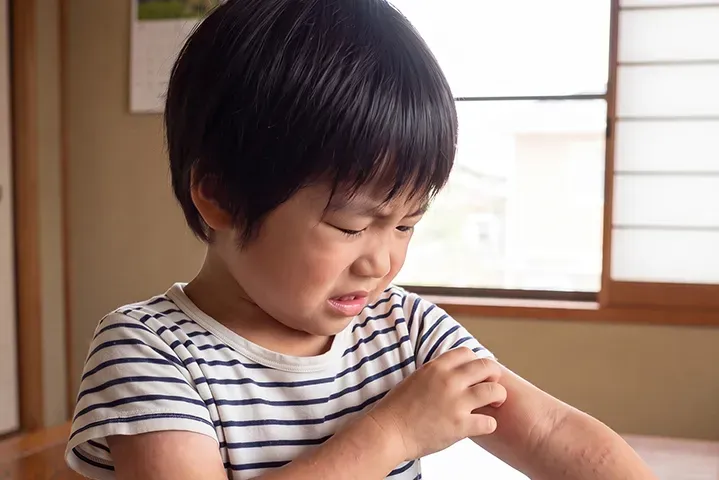 子どものじんましんとダニ｜症状の違い・原因・正しい対処を小児科医が解説