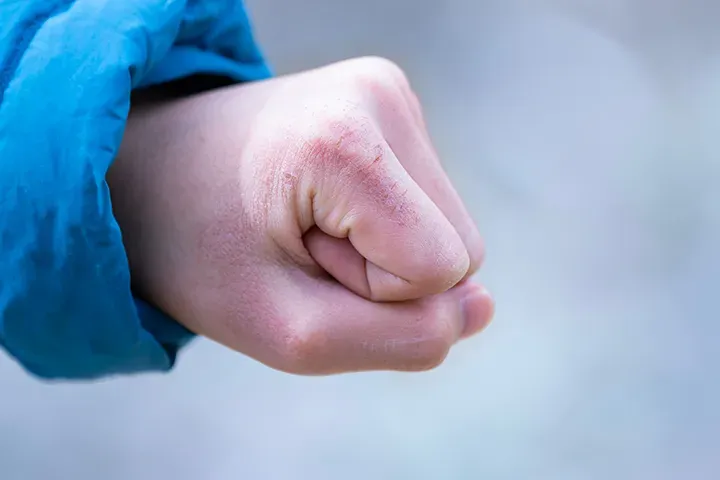 子どものあかぎれの治し方|原因から家庭ケア・受診目安まで小児科医が解説