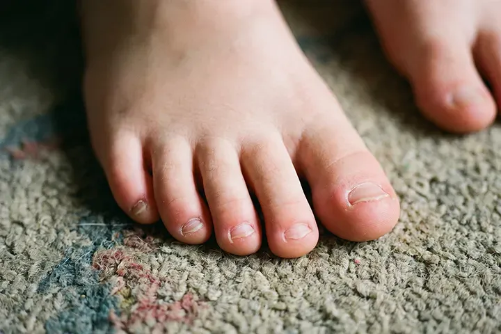 子どもの深爪｜治し方・予防・受診目安を小児科医がやさしく解説