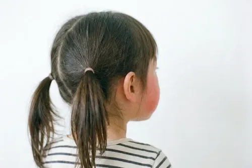 子どものりんご病(伝染性紅斑)とは?症状・うつる時期・登園の目安と家庭ケアを小児科医が解説