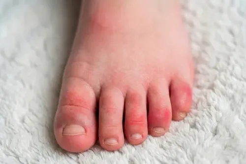 子どものしもやけの治し方は?原因(寒さ・温度差・湿気)と家庭ケア・予防、受診の目安を小児科医が解説